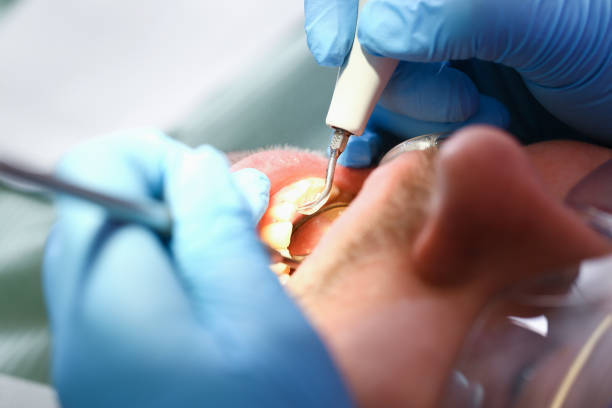 Best Emergency Tooth Extraction in Highpoint, OH